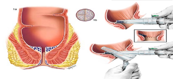 Hemorrhoidectomy Discharge Instructions